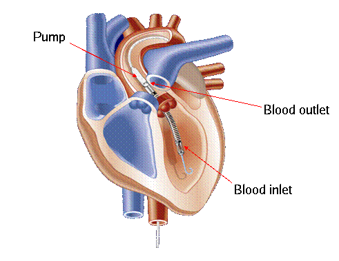 Impella diagram